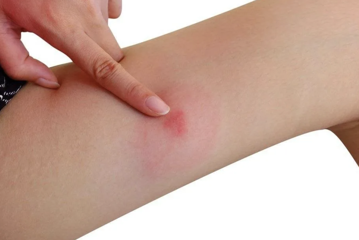 Was sticht, aber ist gefährlicher als Mücken und Wespen? Der gefährlichste Biss des Sommers enthüllt!